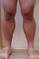 Smooth surface and normal vein pressure after treatment, with complete absence of pain